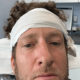 Dave Portnoy hair surgery